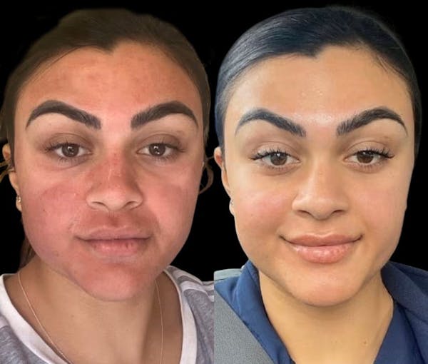 Microneedling Before & After Gallery - Patient 375545 - Image 1