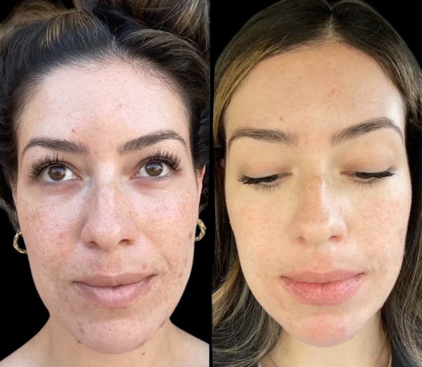 Microneedling Before & After Gallery - Patient 175450 - Image 1