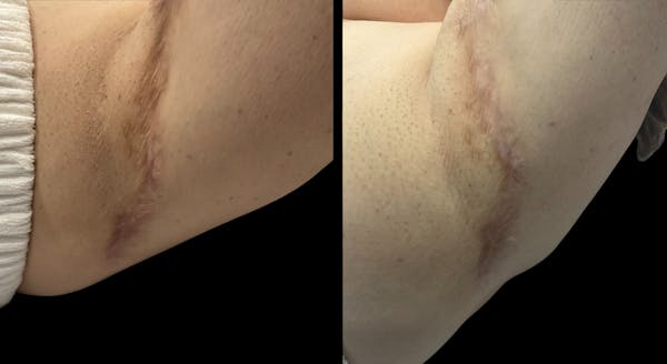 Microneedling Before & After Gallery - Patient 392928 - Image 1