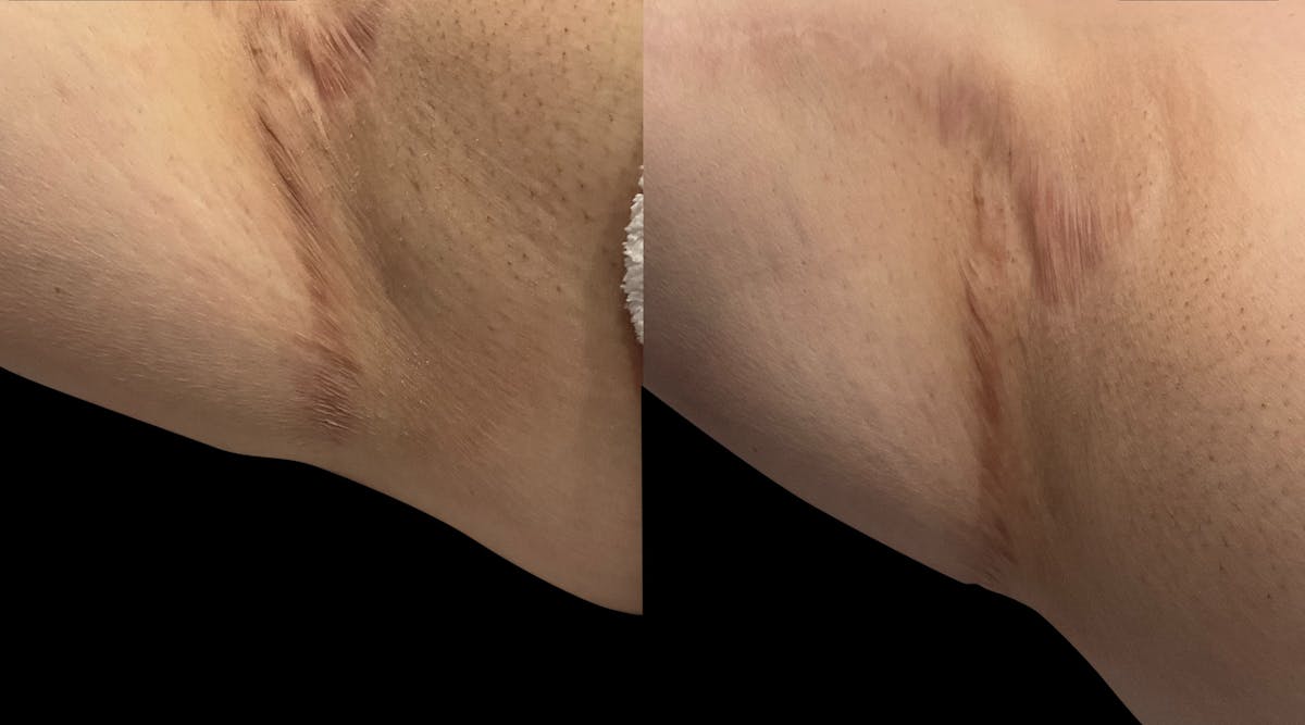 Microneedling Before & After Gallery - Patient 392928 - Image 2