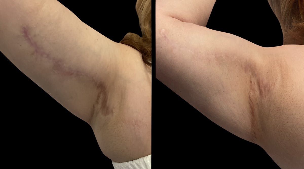 Microneedling Before & After Gallery - Patient 392928 - Image 3