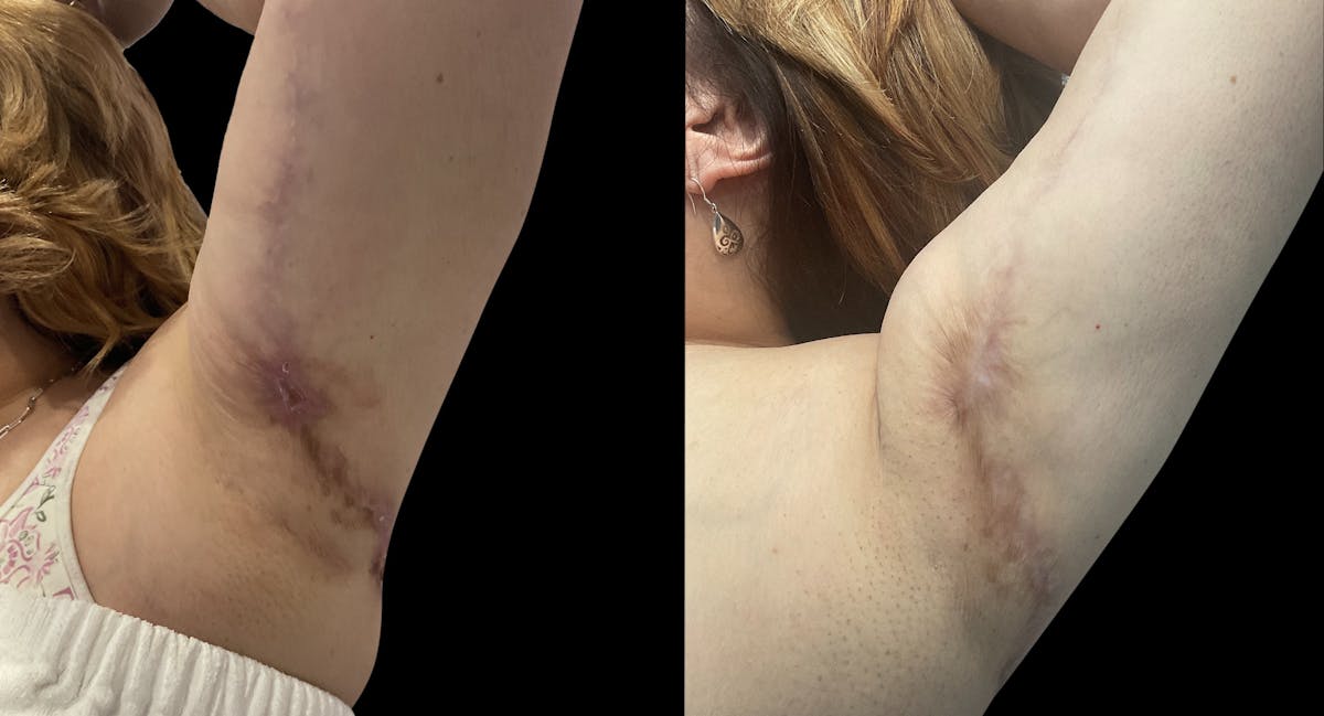 Microneedling Before & After Gallery - Patient 392928 - Image 4