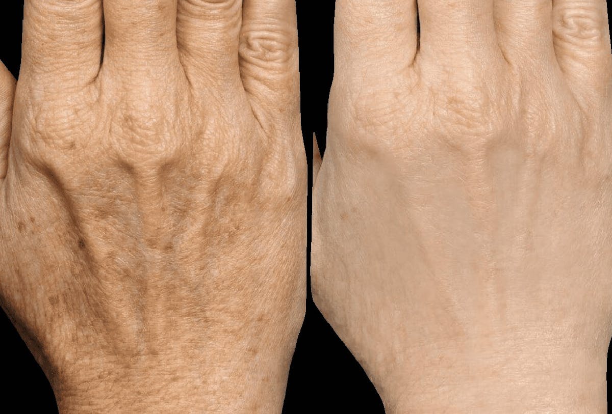 Procell Therapies Before & After Gallery - Patient 325193 - Image 1