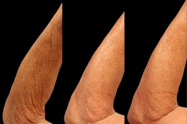 Procell Therapies Before & After Gallery - Patient 115514 - Image 1