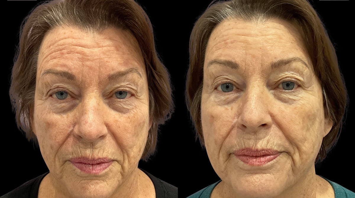 Tribella Before & After Gallery - Patient 320588 - Image 1