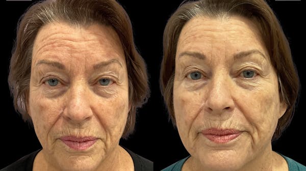 Tribella Before & After Gallery - Patient 320588 - Image 1