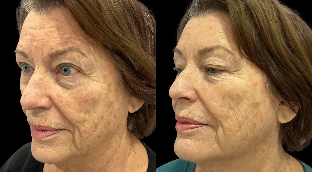 Tribella Before & After Gallery - Patient 320588 - Image 2