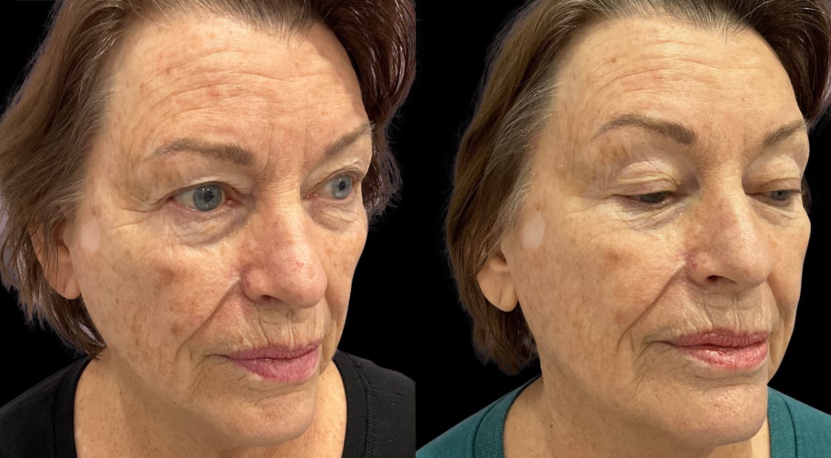 Tribella Before & After Gallery - Patient 320588 - Image 3
