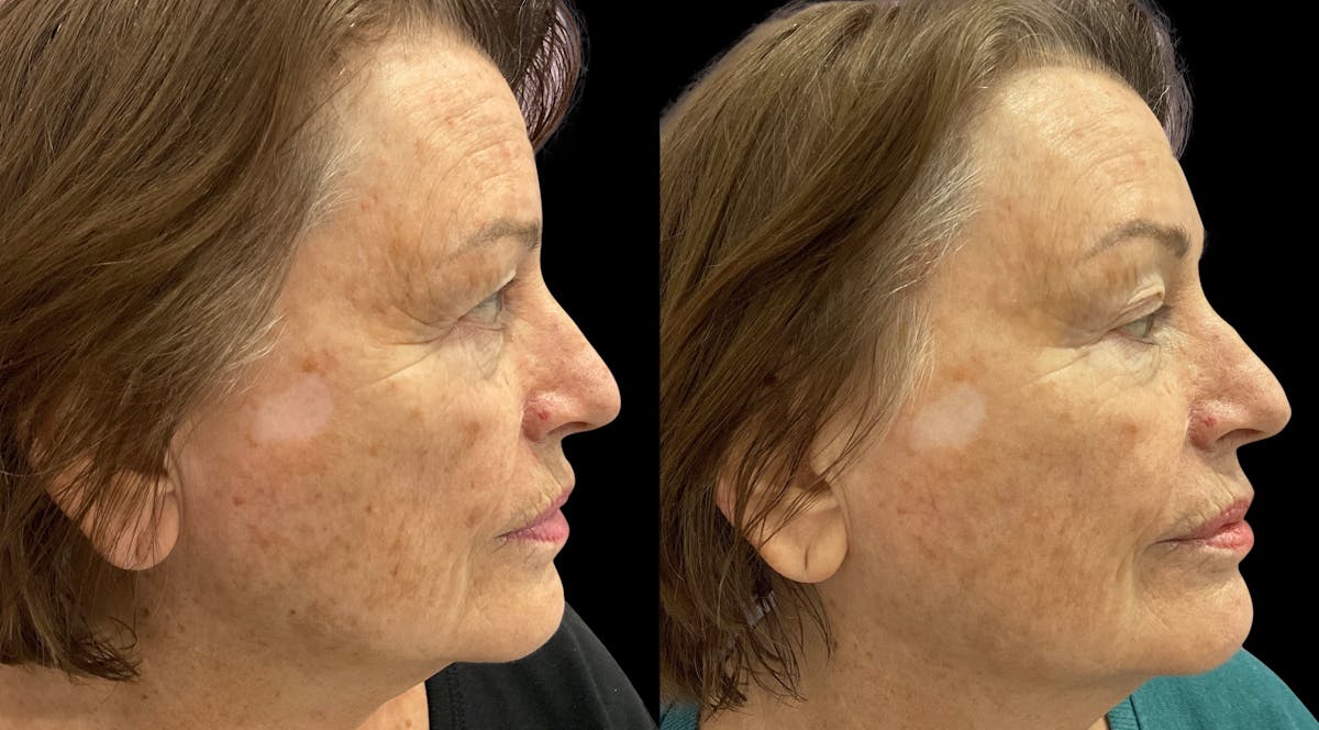 Tribella Before & After Gallery - Patient 320588 - Image 4