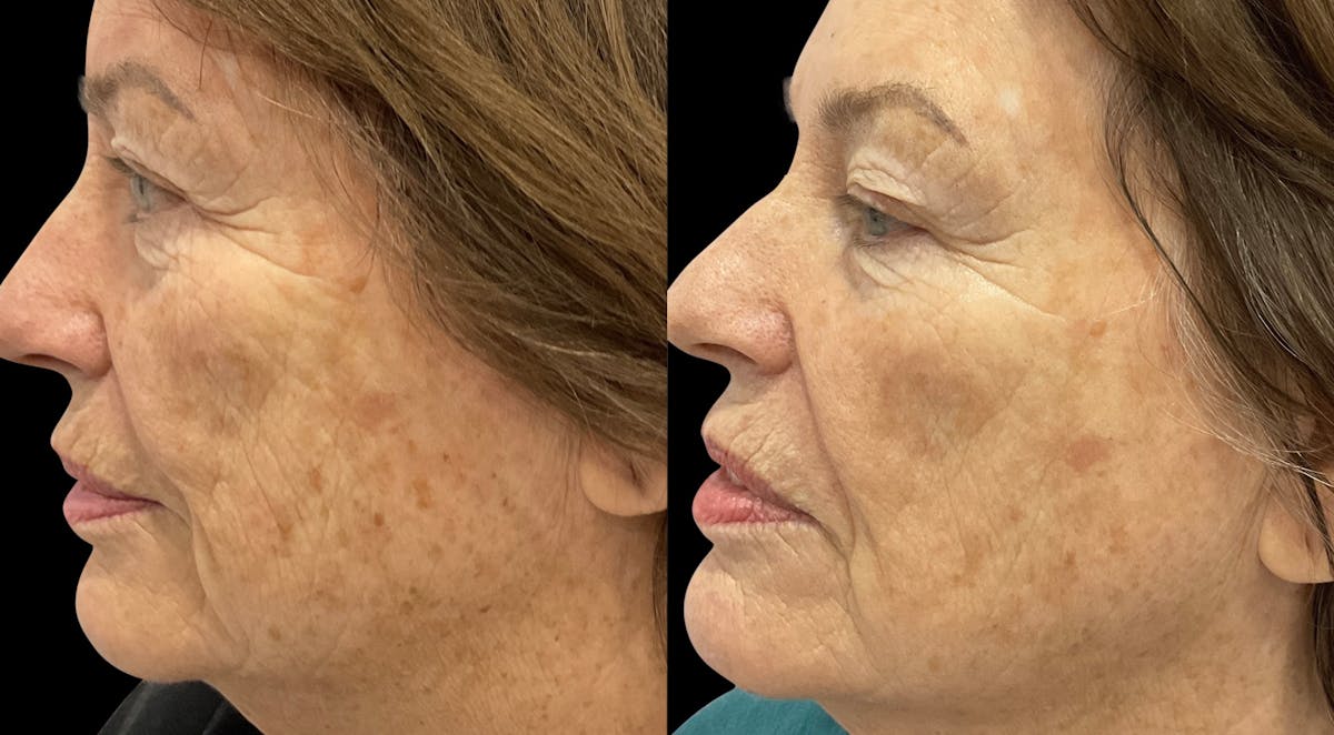 Tribella Before & After Gallery - Patient 320588 - Image 5