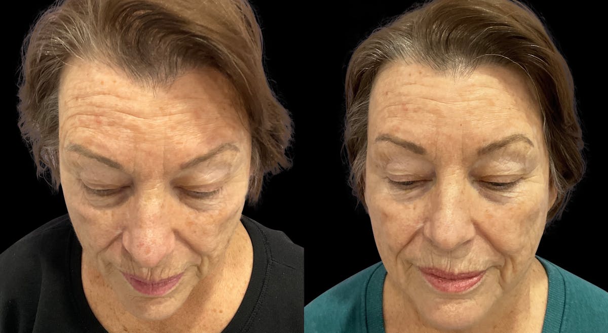 Tribella Before & After Gallery - Patient 320588 - Image 6