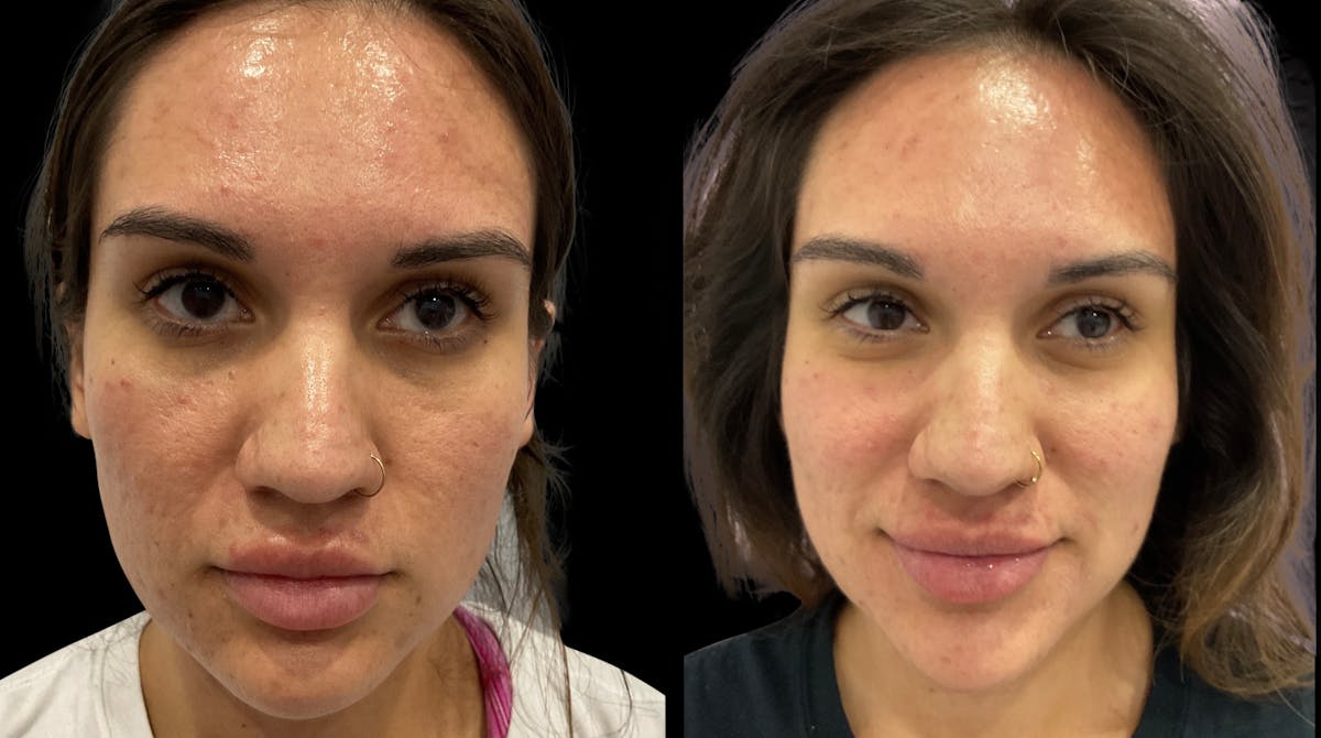 Tribella Before & After Gallery - Patient 414636 - Image 1