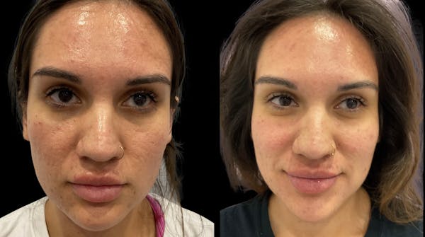 Tribella Before & After Gallery - Patient 414636 - Image 1