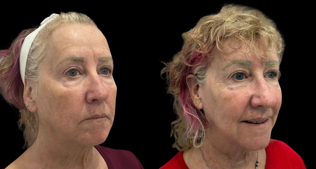 UltraClear® Before & After Gallery - Patient 909286 - Image 1