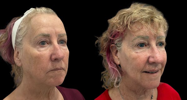 UltraClear® Before & After Gallery - Patient 909286 - Image 1
