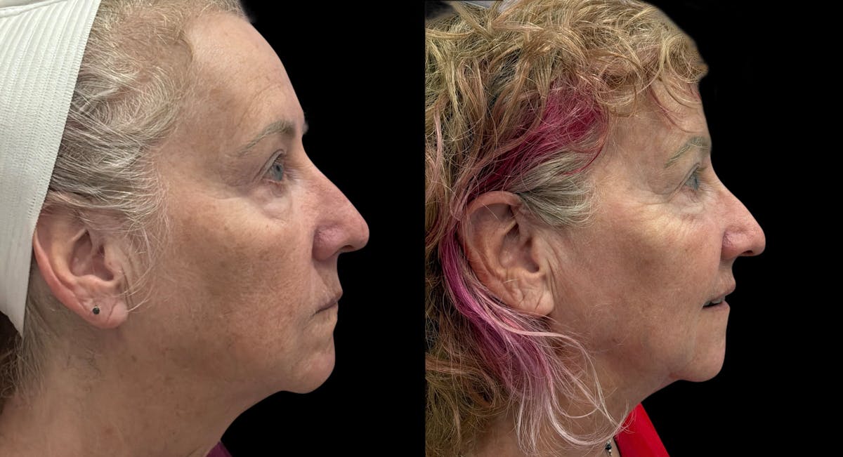 UltraClear® Before & After Gallery - Patient 909286 - Image 2