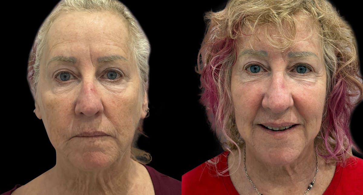 UltraClear® Before & After Gallery - Patient 909286 - Image 3