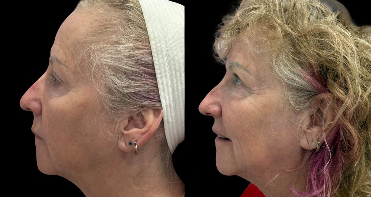 UltraClear® Before & After Gallery - Patient 909286 - Image 4