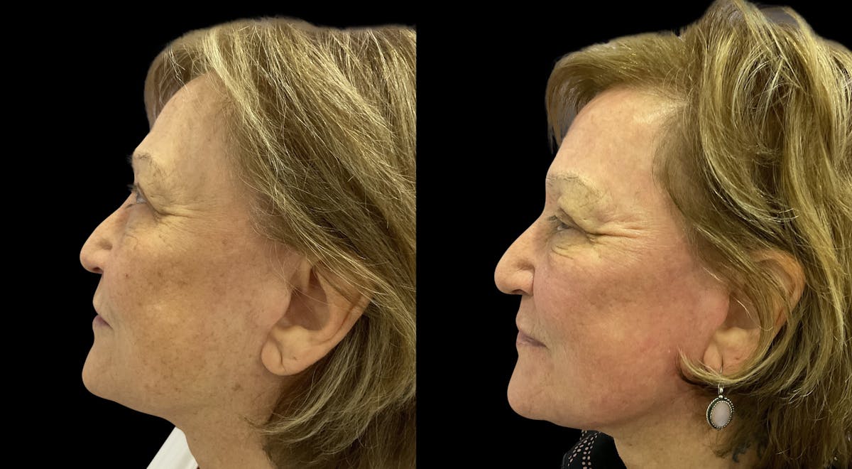 UltraClear® Before & After Gallery - Patient 207746 - Image 1