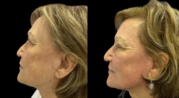 UltraClear® Before & After Gallery - Patient 207746 - Image 1