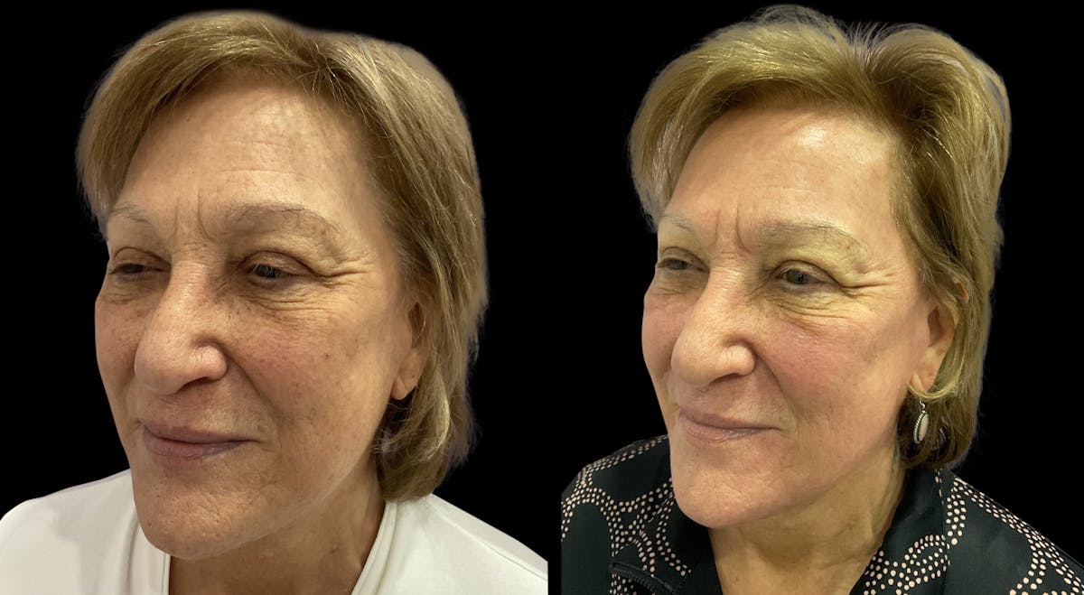 UltraClear® Before & After Gallery - Patient 207746 - Image 2