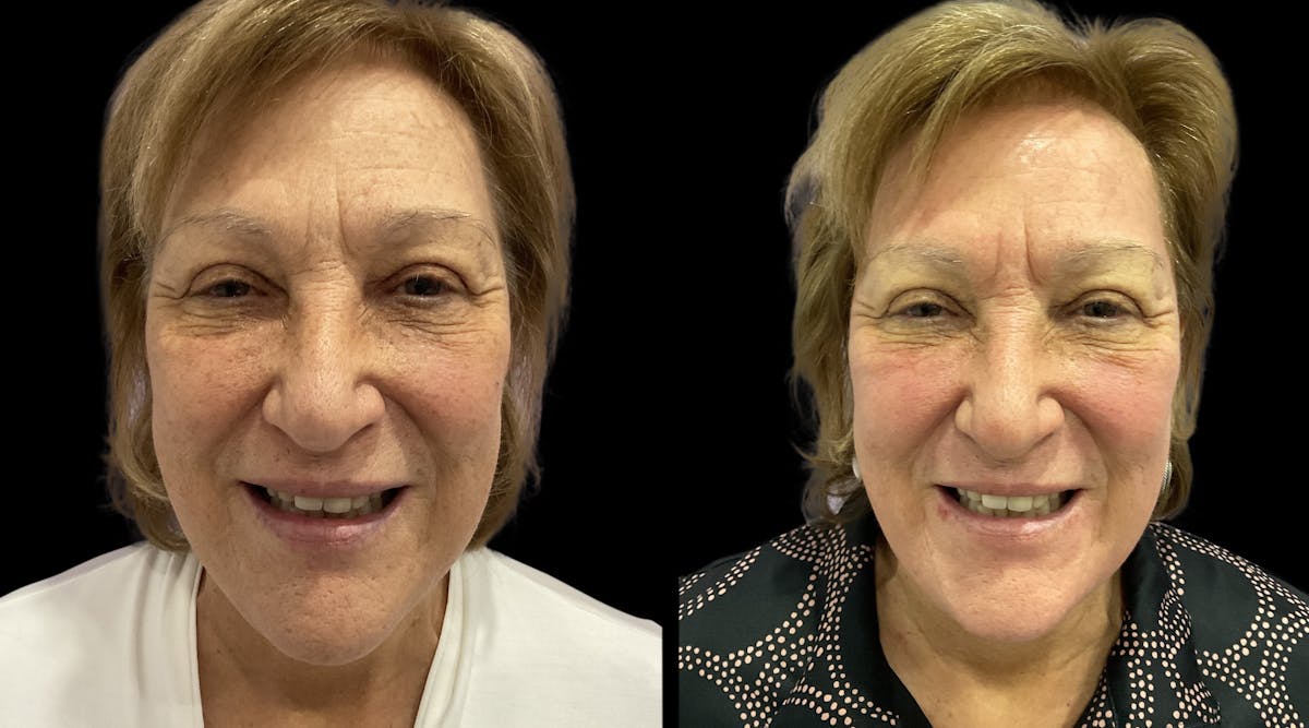 UltraClear® Before & After Gallery - Patient 207746 - Image 3