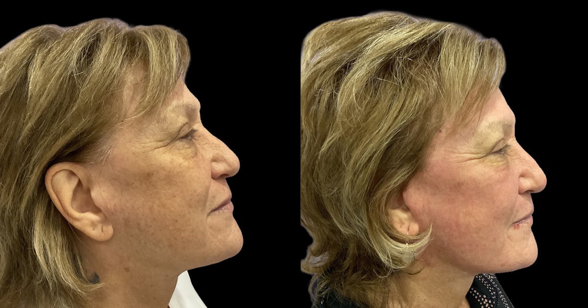 UltraClear® Before & After Gallery - Patient 207746 - Image 4