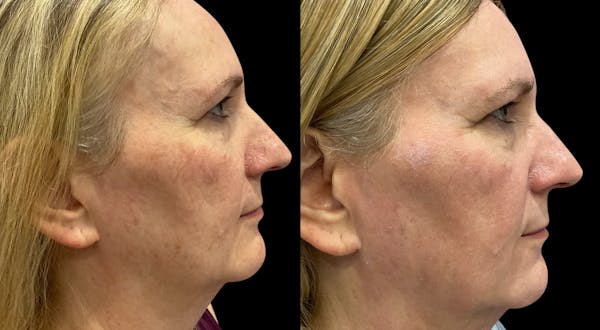 UltraClear® Before & After Gallery - Patient 360692 - Image 1