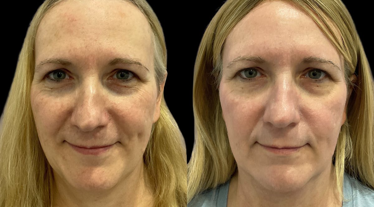 UltraClear® Before & After Gallery - Patient 360692 - Image 2
