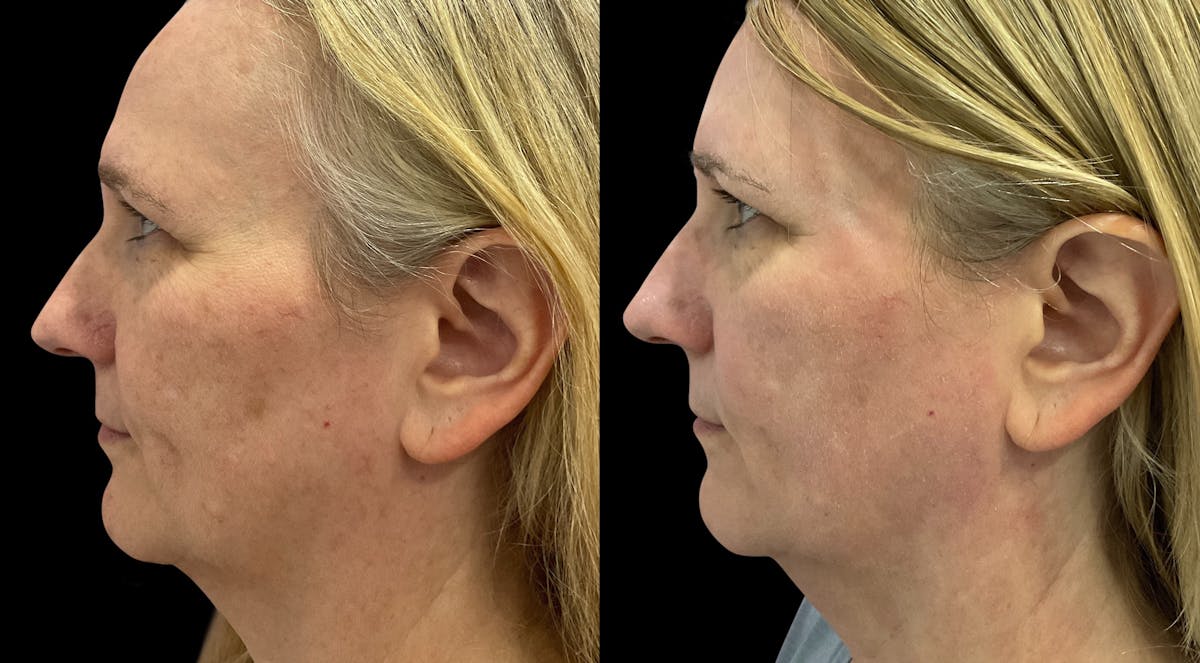 UltraClear® Before & After Gallery - Patient 360692 - Image 3