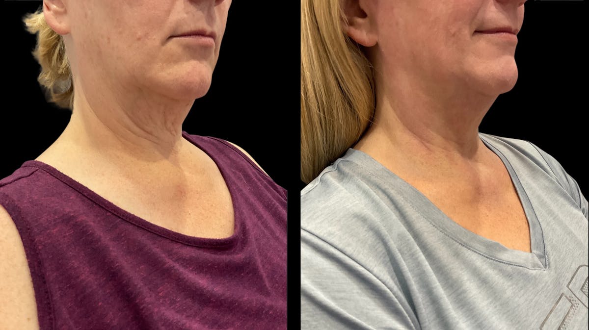 UltraClear® Before & After Gallery - Patient 360692 - Image 4