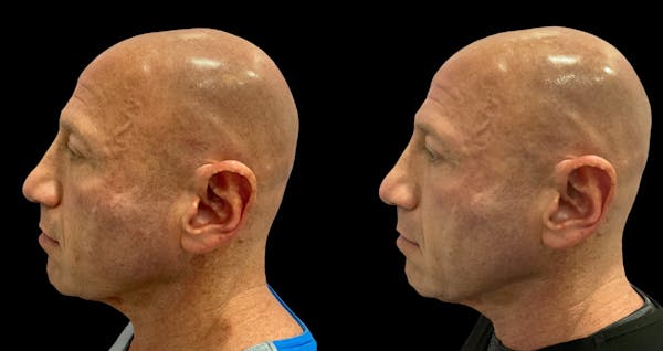 UltraClear® Before & After Gallery - Patient 347199 - Image 1