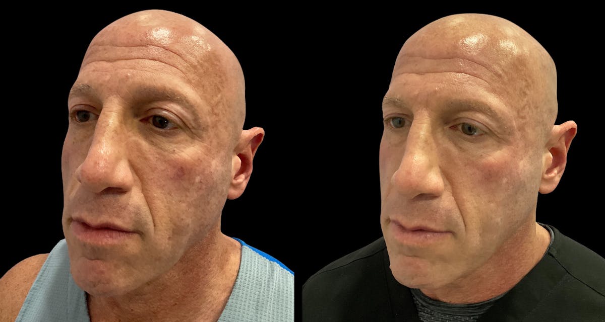 UltraClear® Before & After Gallery - Patient 347199 - Image 2