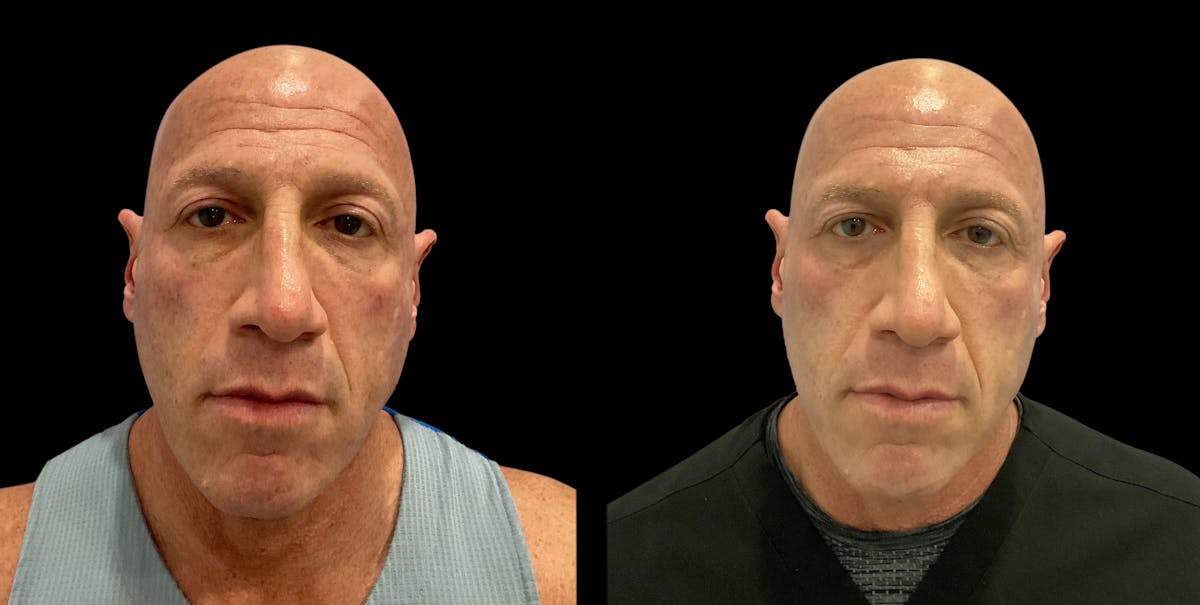 UltraClear® Before & After Gallery - Patient 347199 - Image 3