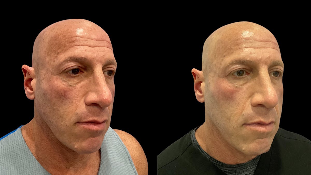 UltraClear® Before & After Gallery - Patient 347199 - Image 4