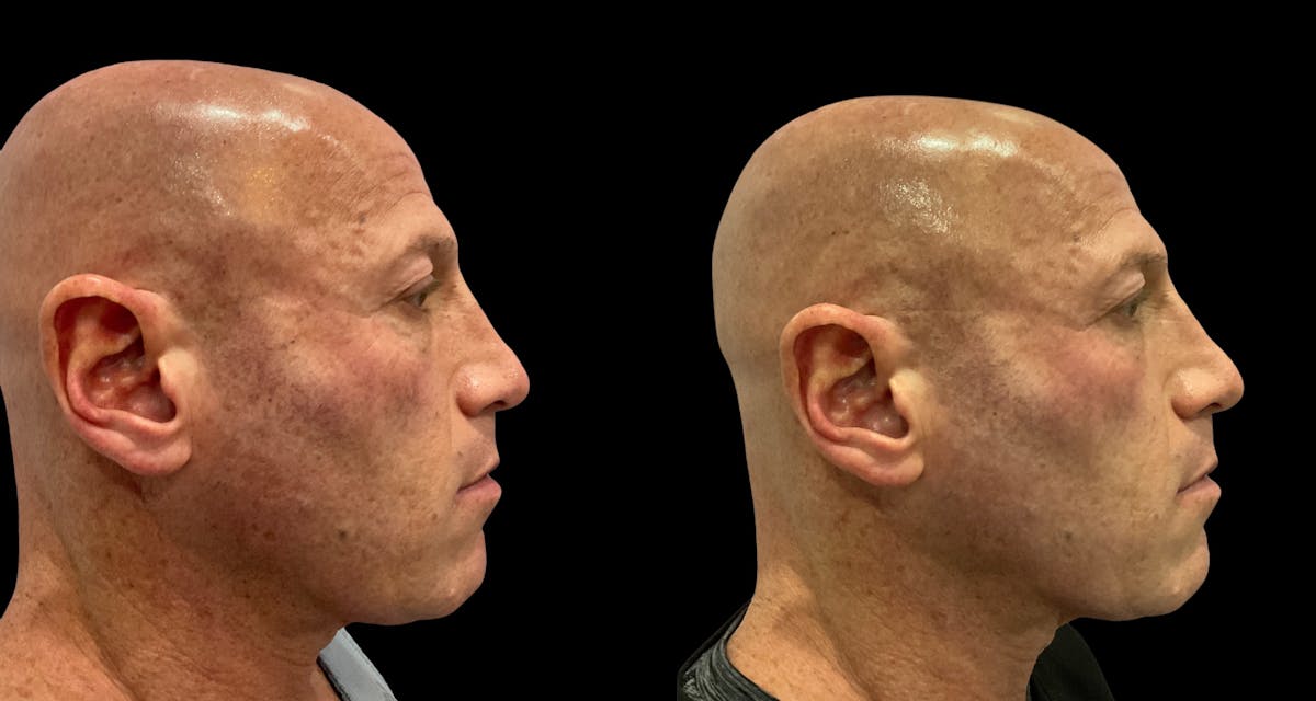 UltraClear® Before & After Gallery - Patient 347199 - Image 5