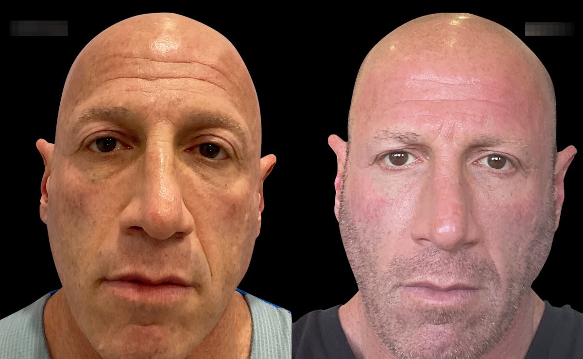 UltraClear® Before & After Gallery - Patient 347199 - Image 6
