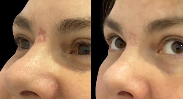 UltraClear® Before & After Gallery - Patient 321817 - Image 1