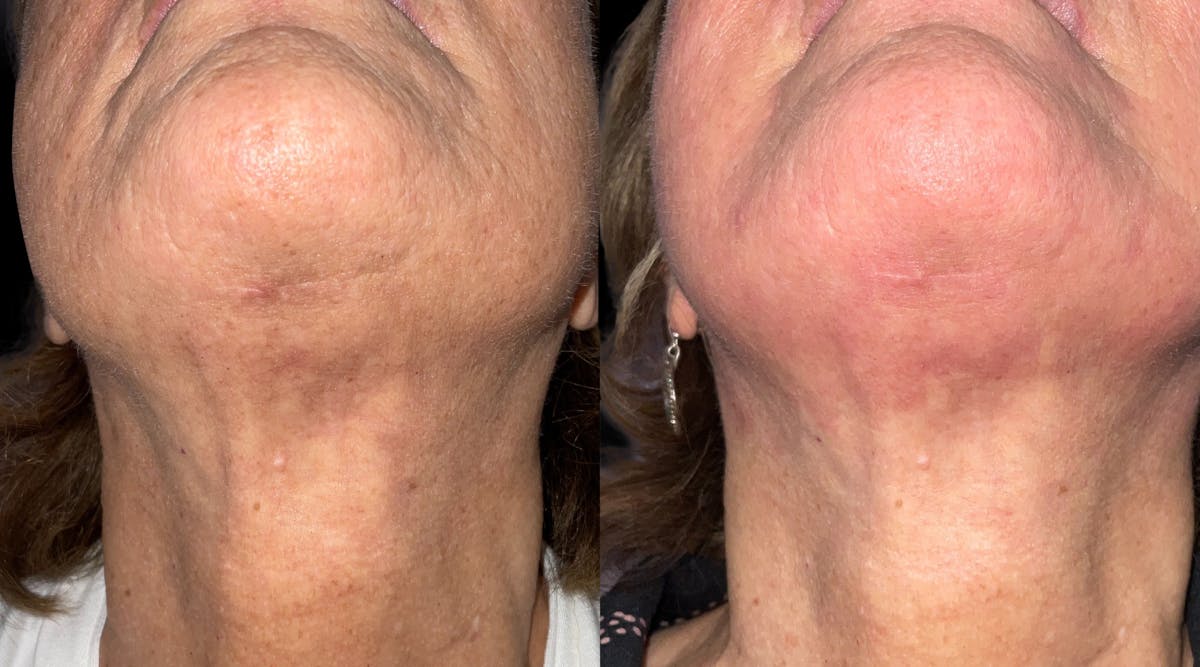 UltraClear® Before & After Gallery - Patient 105145 - Image 1