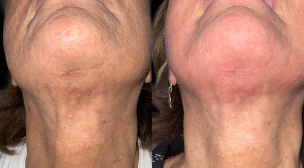 UltraClear® Before & After Gallery - Patient 105145 - Image 1