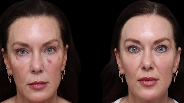 UltraClear® Before & After Gallery - Patient 211871 - Image 1