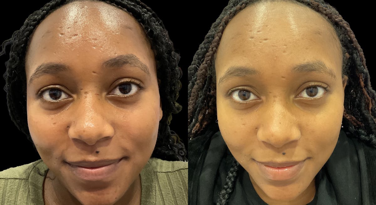 VivaMd Before & After Gallery - Patient 413874 - Image 1
