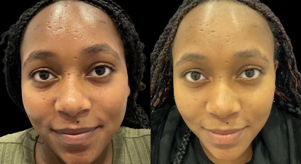 VivaMd Before & After Gallery - Patient 413874 - Image 1