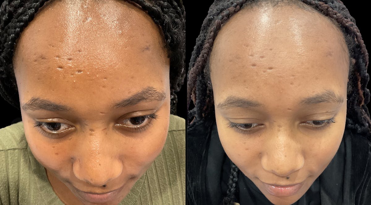 VivaMd Before & After Gallery - Patient 413874 - Image 2