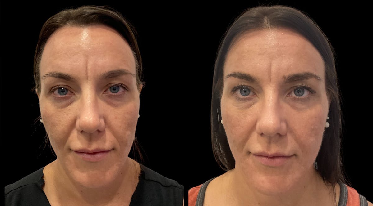 Vivace® Before & After Gallery - Patient 275344 - Image 2