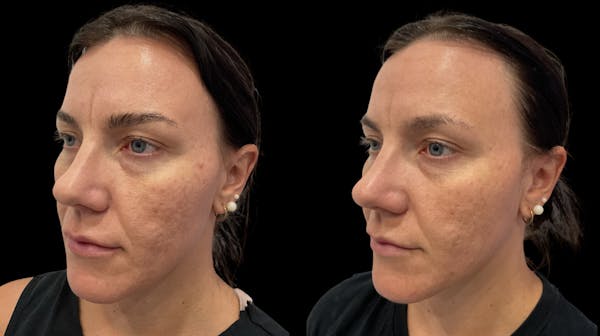 Vivace® Before & After Gallery - Patient 275344 - Image 1