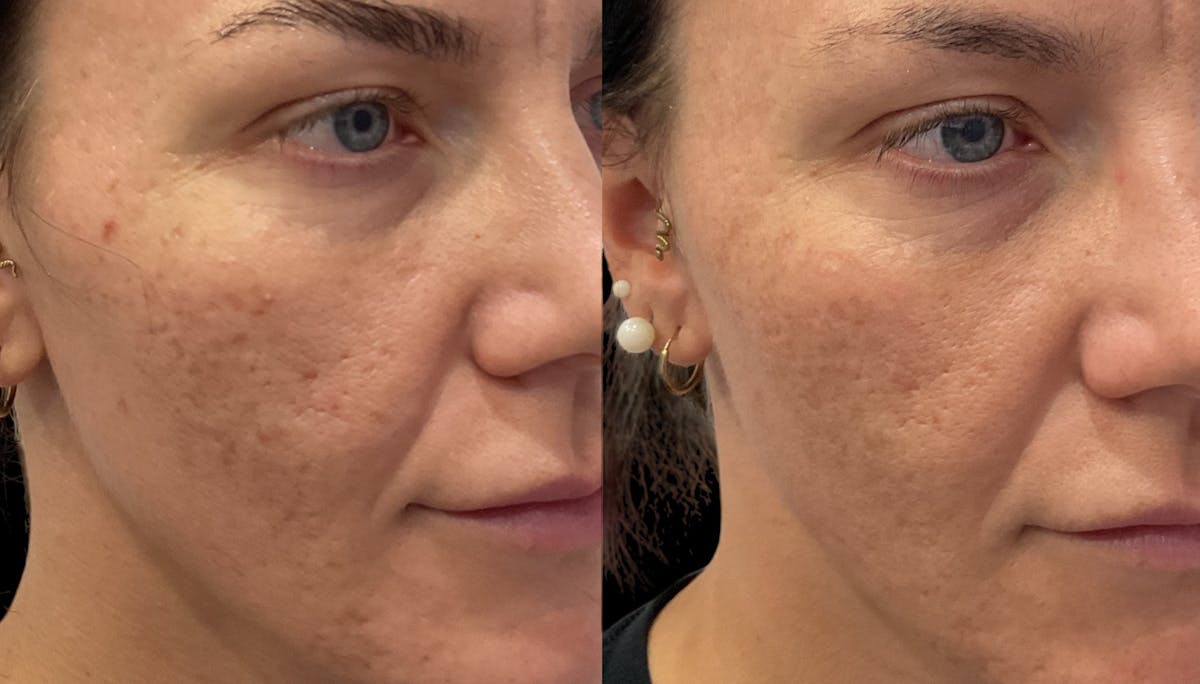 Vivace® Before & After Gallery - Patient 275344 - Image 3