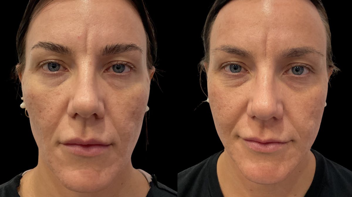Vivace® Before & After Gallery - Patient 275344 - Image 4