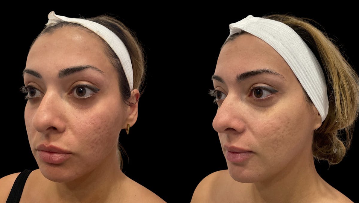 Vivace® Before & After Gallery - Patient 250841 - Image 1