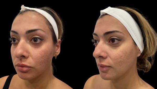 Vivace® Before & After Gallery - Patient 250841 - Image 1